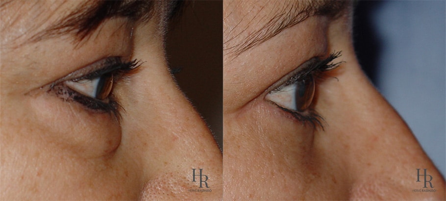 Blépharoplastie inférieure avant après - Chirurgie poche sous les yeux | Clinique du Dr Raspaldo | Genève